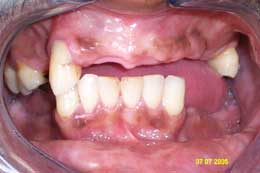 Dentures
